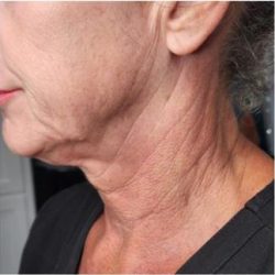 Sofwave Before & After Patient #1601